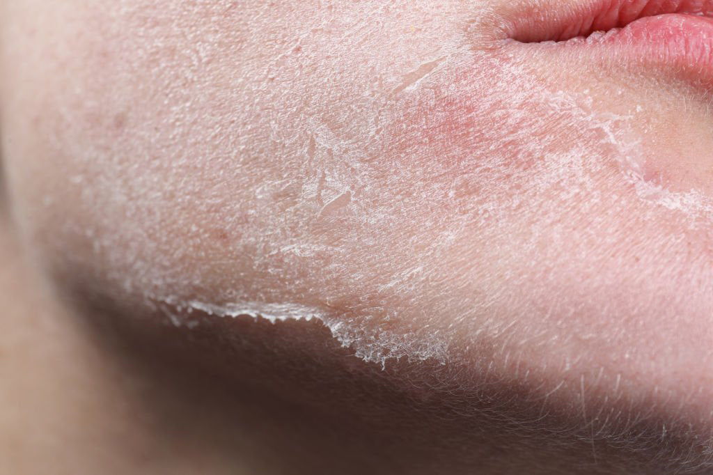 Skin Concern: Dryness