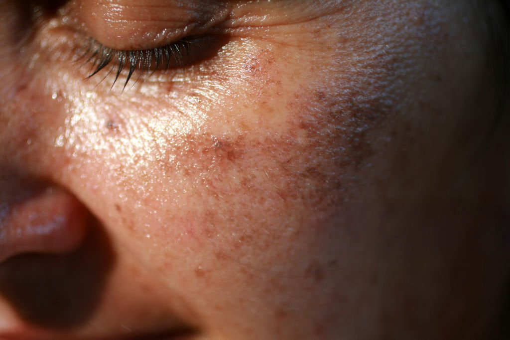 Skin Concern: Dullness