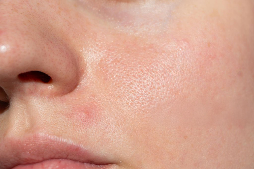 Skin Concern: Oily Skin