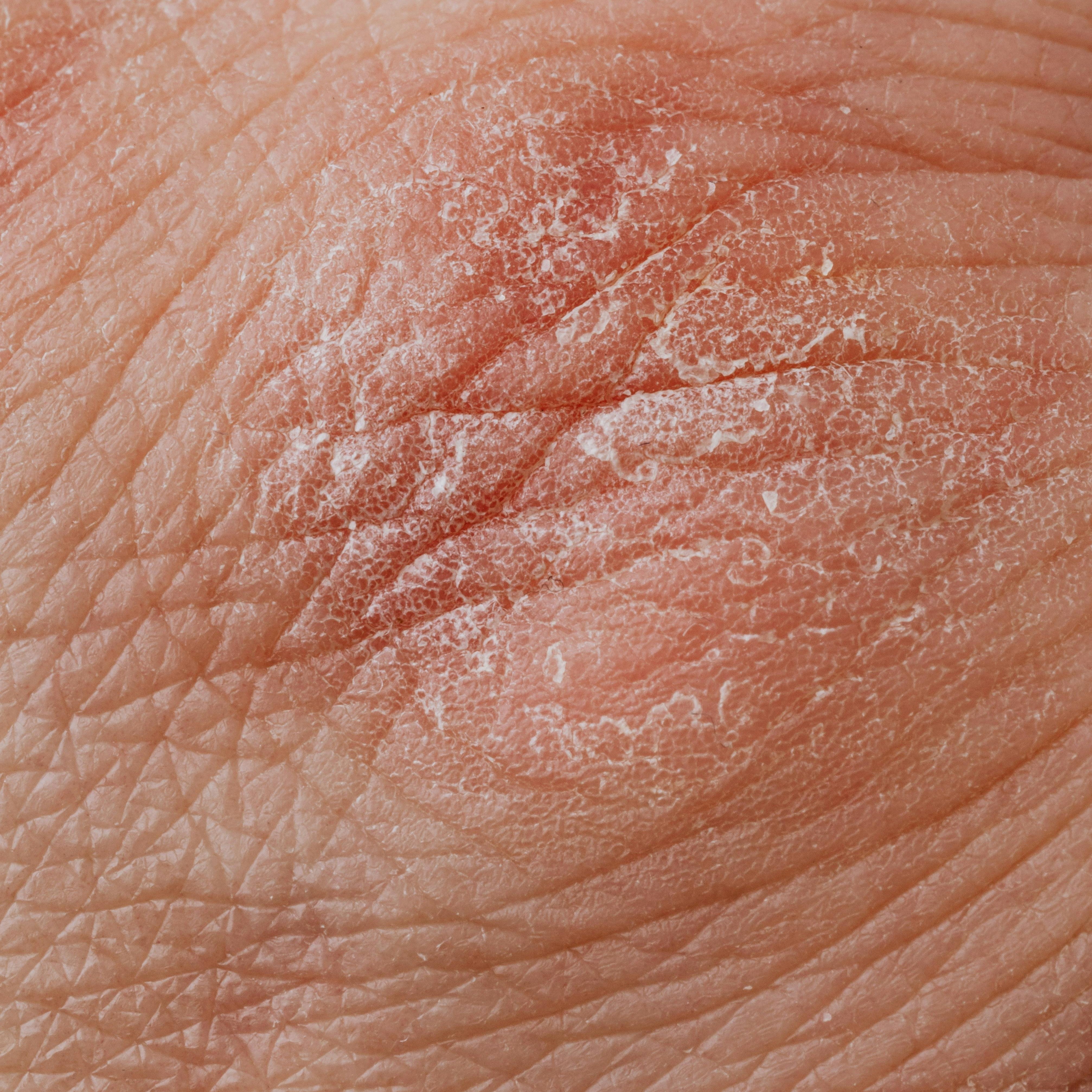 Dry Skin Detail