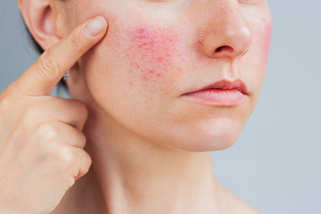 Skin Concern: Redness