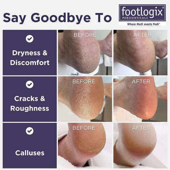 Footlogix Ultimate "W Domu" Zestaw Pielęgnacji Stóp (100ml)