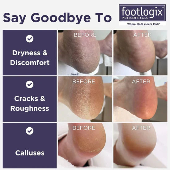 Footlogix Dwustronna Pilnik do Stóp z Gumową Rączką - Grubo/Drobno