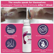 Footlogix Formuła na Łuszczącą się Skórę (125ml)