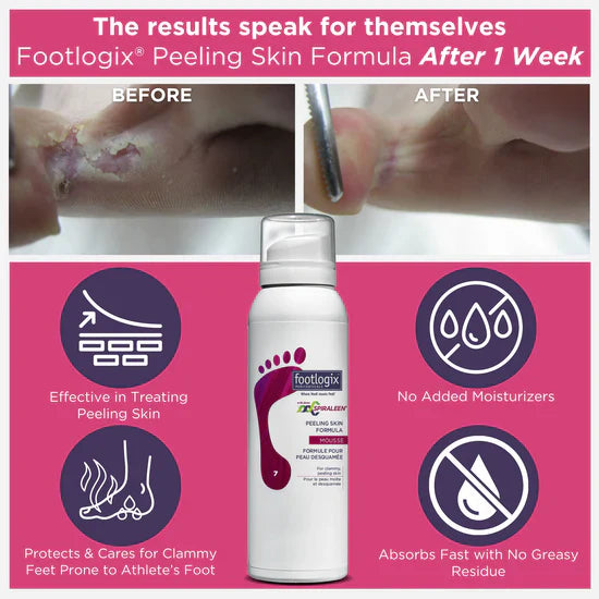 Footlogix Formuła na Łuszczącą się Skórę (125ml)